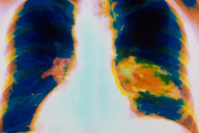 Pleuritis