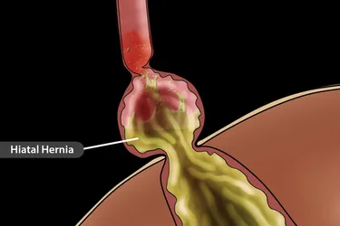 A hiatal hernia is when your stomach bulges up into your chest through an opening in your diaphragm. (Photo Credit: Monica Schroeder/Science Source)
