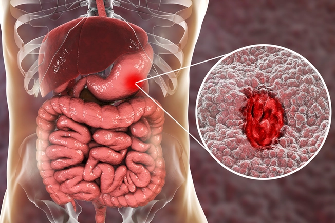 Stomach Ulcer