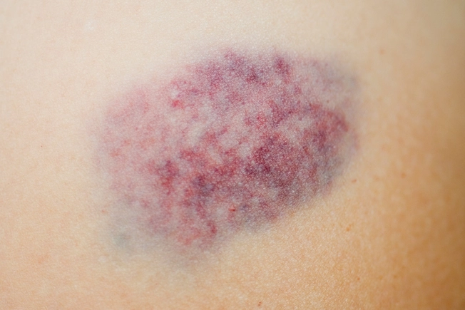 Easy Bruising