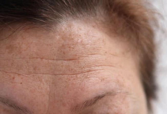 Target Wrinkles With Retinoids