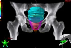 cancer treatment plan