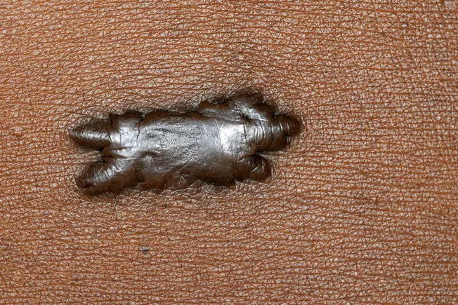 Keloids