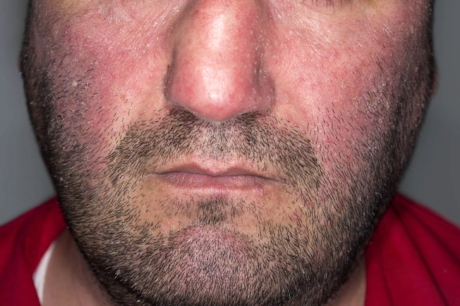 Atopic Dermatitis