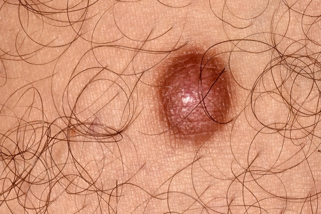 Dermatofibroma