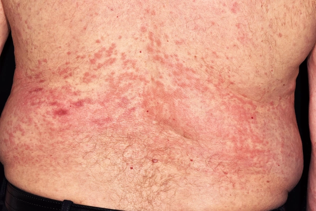 Hives