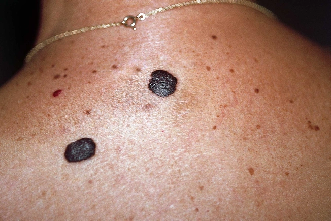 Seborrheic Keratosis