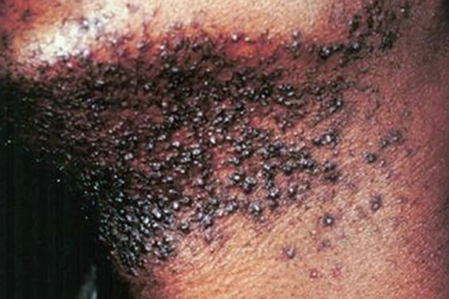 Pseudofolliculitis barbae/Folliculitis