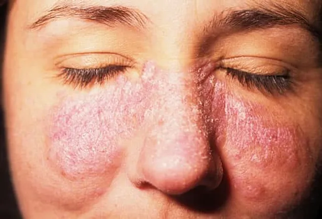 Lupus In Explained In Pictures Rashes Location Pain Nail Problems Lupus In Explained In Pictures Rashes Location Pain Nail Problems