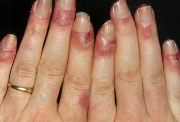 Acute Lupus On Fingernails