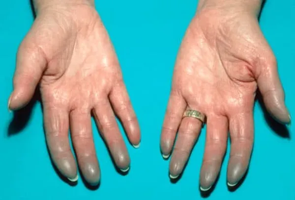 Lupus Rash On Womans Hands