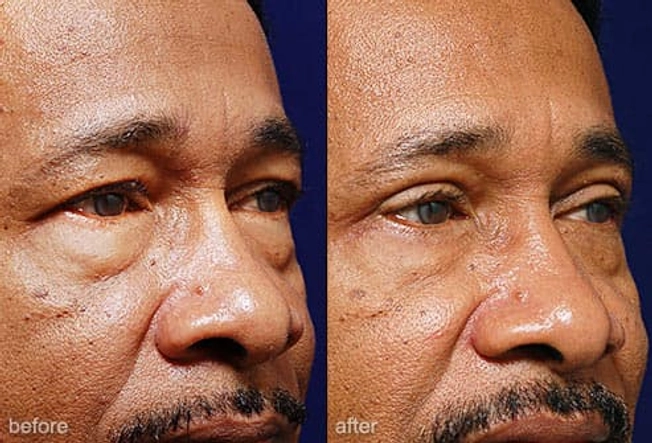 Eyelid Surgery