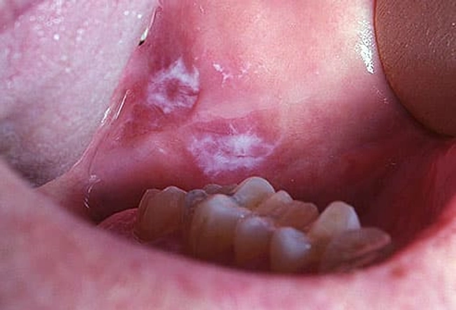 17 Mouth & Tongue Problems: Pictures of Sores, Blisters, Bumps, and More