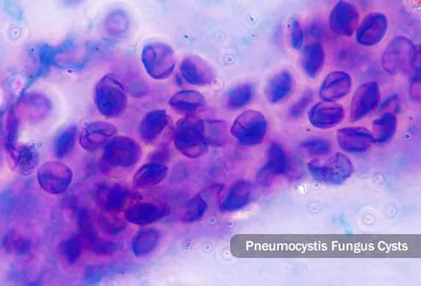 pneumocystis mantarı