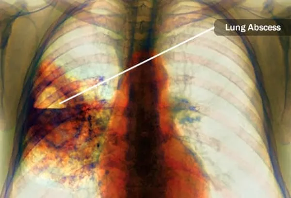 akciğer apsesinin röntgeni