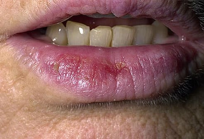 Actinic Cheilitis (Farmer's Lip)