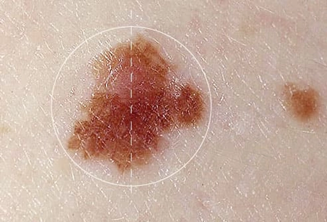 Know Your ABCDEs: 'A' is for Asymmetry