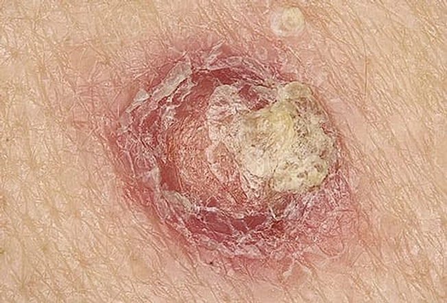 Squamous Cell Carcinoma