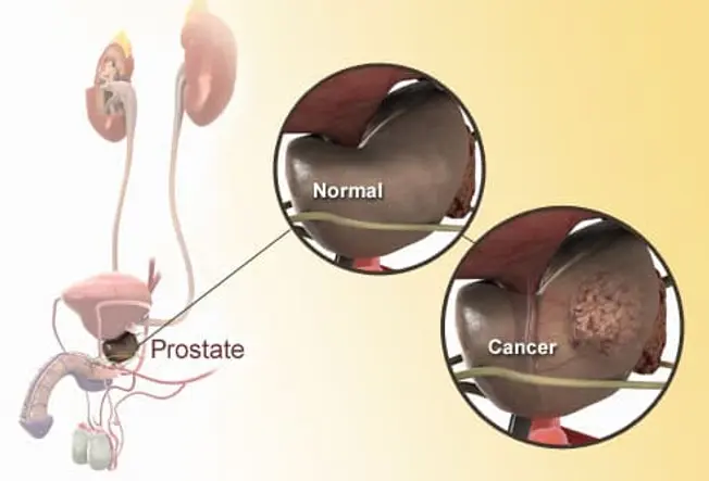 What Is Prostate Cancer?