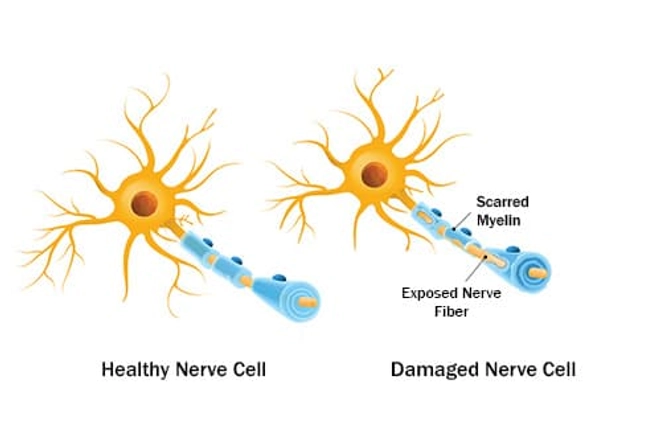 Multiple Sclerosis (MS)