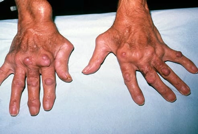 Rheumatoid Arthritis