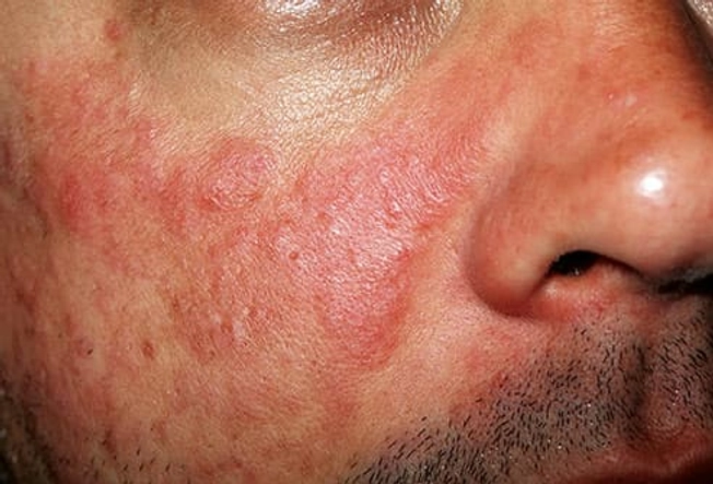 Lupus