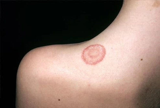 Does Ringworm Mean I Have Worms?