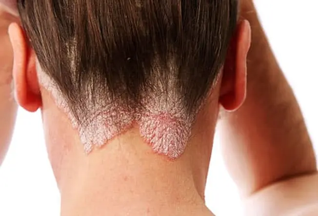 What Is Scalp Psoriasis?