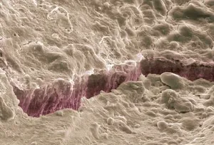 Cracked Tooth Enamel