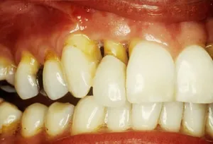 Close Up of Gingival Recession
