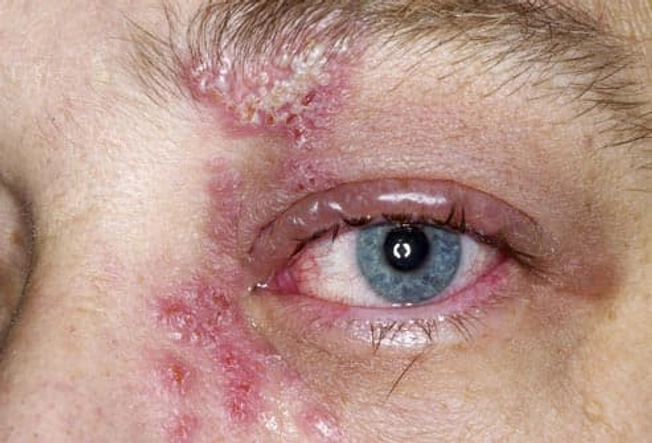 Other Complications of Shingles