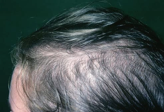 Female-Pattern Baldness