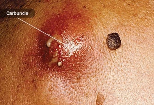 Boils and Carbuncles