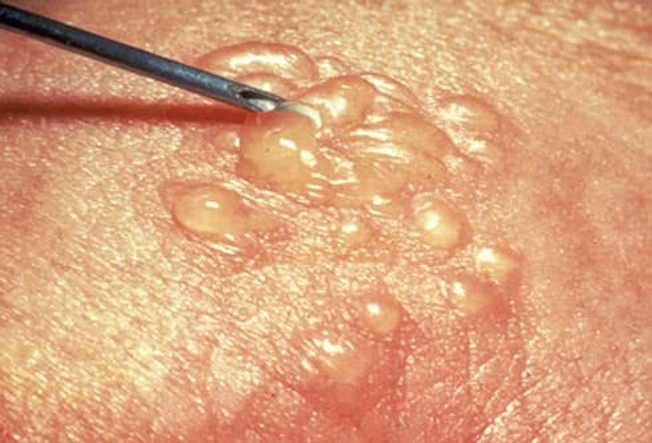Herpes