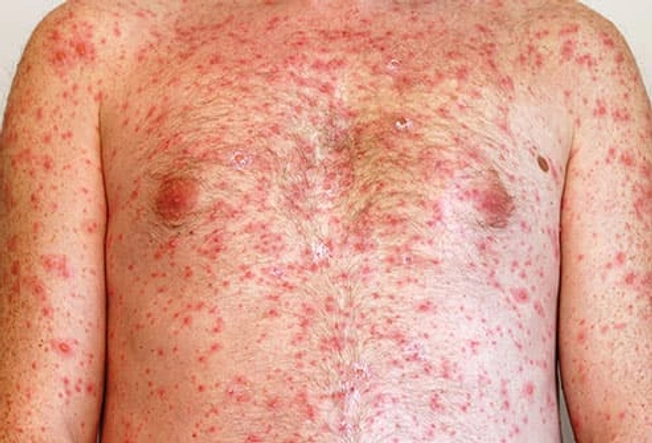 Chickenpox