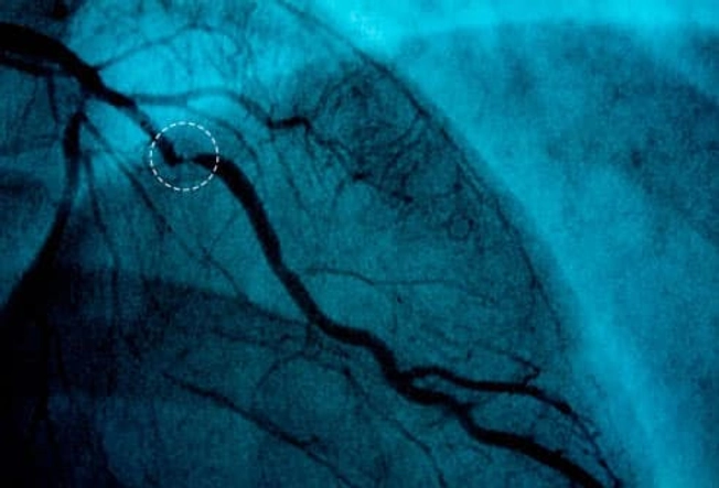 Heart Disease and ED