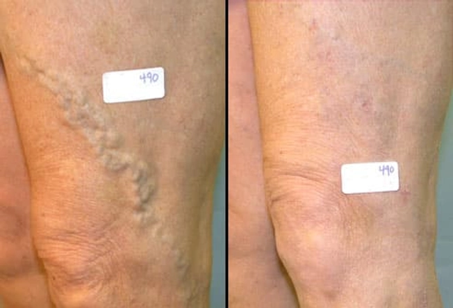 Vein Surgery: Before and After