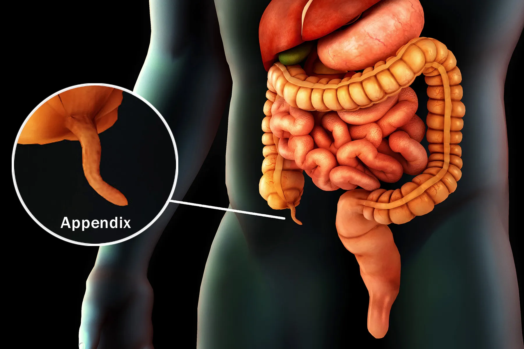 Tiny Organ, Long-Lasting Pain: Mystery of Chronic Appendicitis  - web md