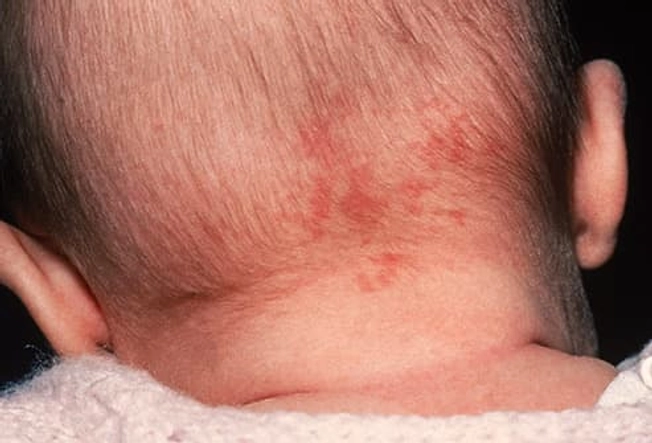Some birthmarks will disappear.