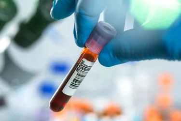 A blood test can check for hepatitis A. The presence of certain substances is a sign that you have an active infection or might have had one in the past. (Photo credit: SCIENCE PHOTO LIBRARY/Getty Images)