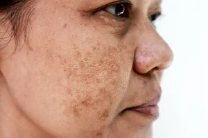 Melasma is often seen in women, but men can get it, too. Sunblock, either with clothing or strong sunscreen, can help.