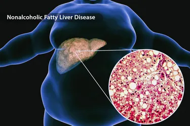 With diet and exercise, fatty liver disease can be reversed. (Photo Credit: iStock/Getty Images)