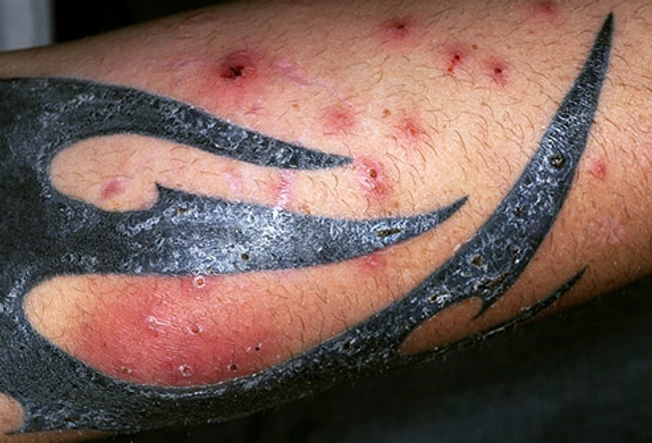 Tattoo Risks: Infection