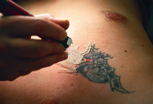 Tattoo Removal Risks