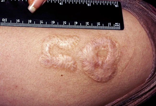 Tattoo Removal Risks: Scarring