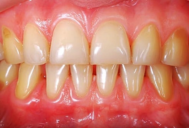 2. Stained Teeth