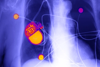 A Pacemaker for Advanced Heart Failure