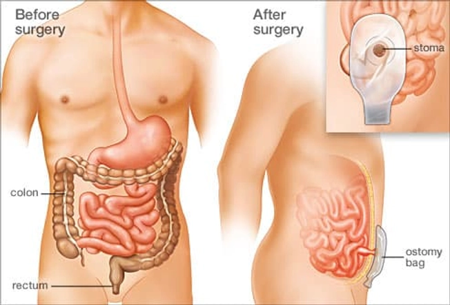 Proctocolectomy: Removal of Colon and Rectum