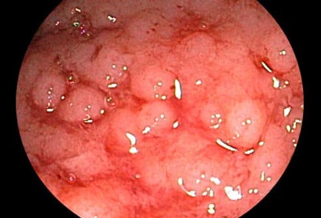 Ulcerative Colitis or Crohn's?
