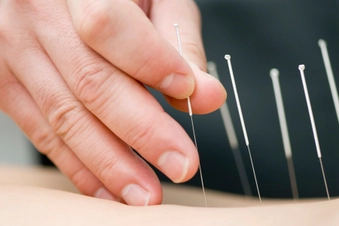 Tap Into Acupuncture